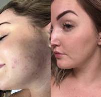 Microneedling