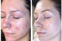 Microneedling